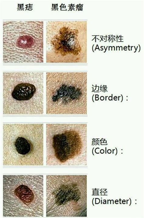 身上有很多痣|你身上的痣会癌变吗？医生分析了100多颗黑痣，快来。